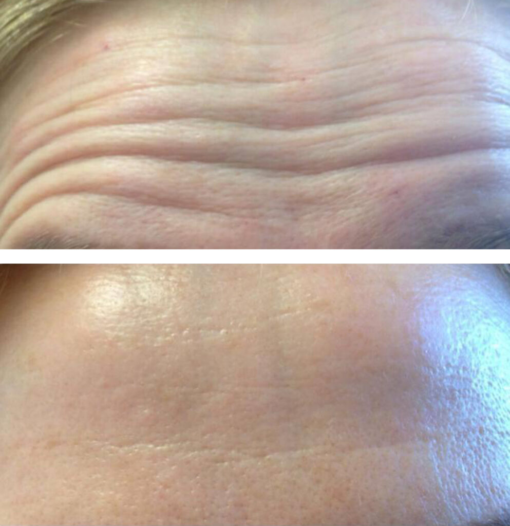 Botox wrinkles treatment