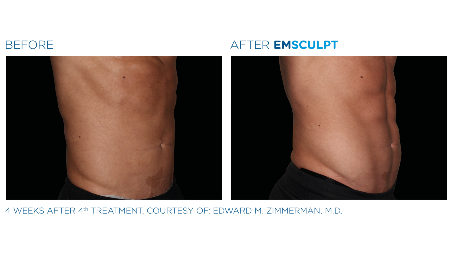 Emsculpt | Sculpt Your Body & Build Muscle | Maya Medi Spa