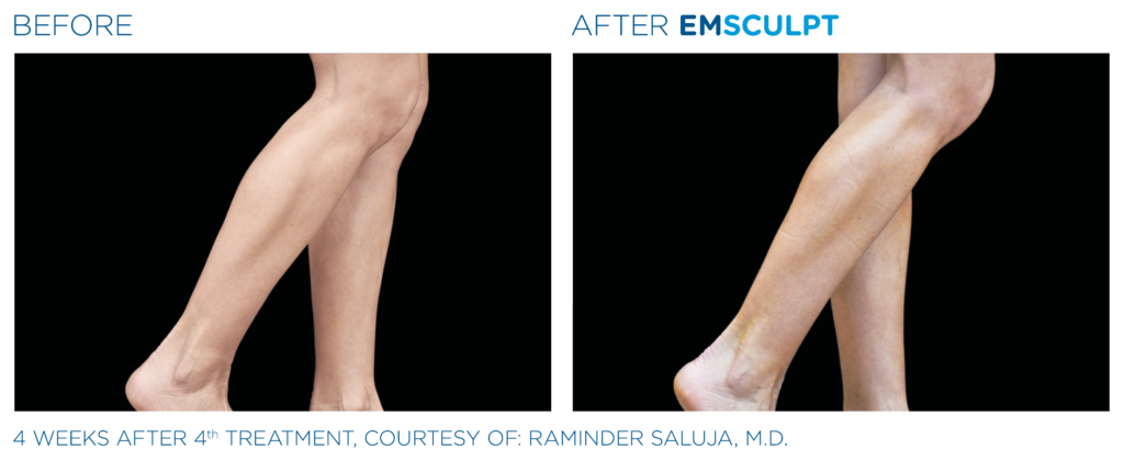 Emsculpt before & after female-legs