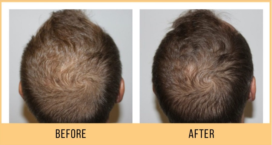Hair Loss Treatment - hydrafacial keravive