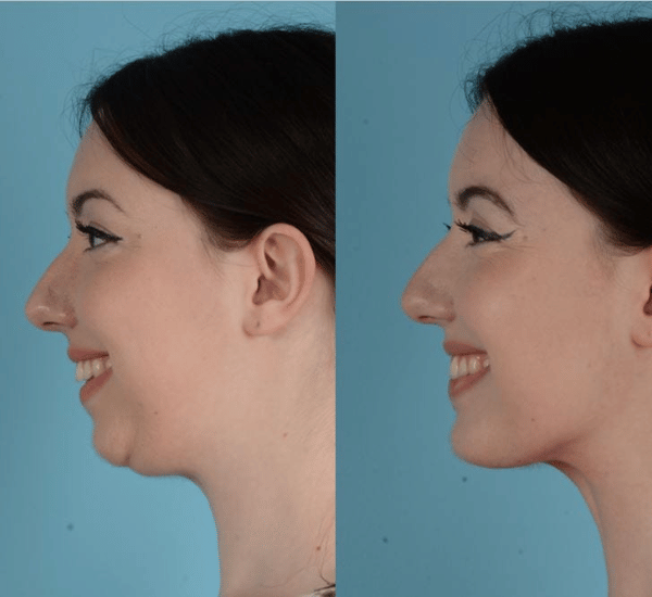 Before After Facial Implants 1 Maya Medi Spa | Best Beauty Clinic in India