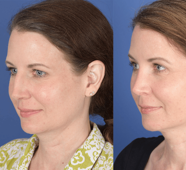 Before After Facial Implants 2 Maya Medi Spa | Best Beauty Clinic in India
