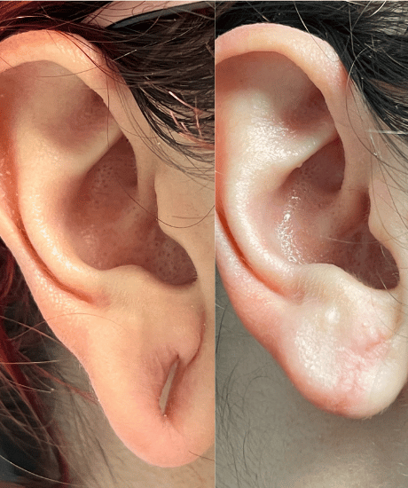 Final Ear Lobe Repair Before AFter 2 Maya Medi Spa | Best Beauty Clinic in India