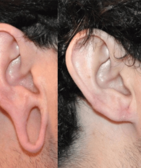 Final Ear Lobe Repair Before AFter Maya Medi Spa | Best Beauty Clinic in India