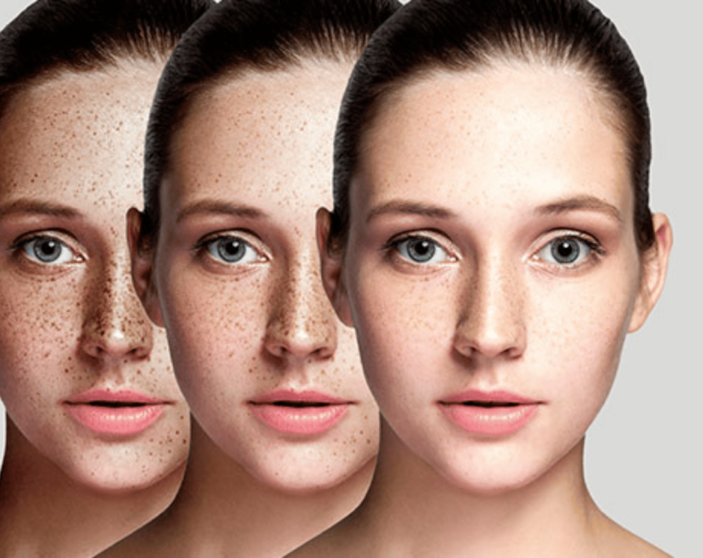 What is DERMAMELAN Treatment at Maya MediSpa Maya Medi Spa | Best Beauty Clinic in India