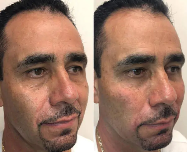 Anti-Aging Treatment in Indiranagar